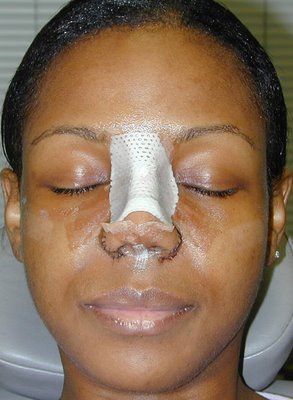 Black Women Nose